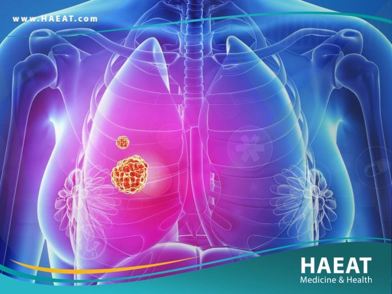 سرطان الرئه
