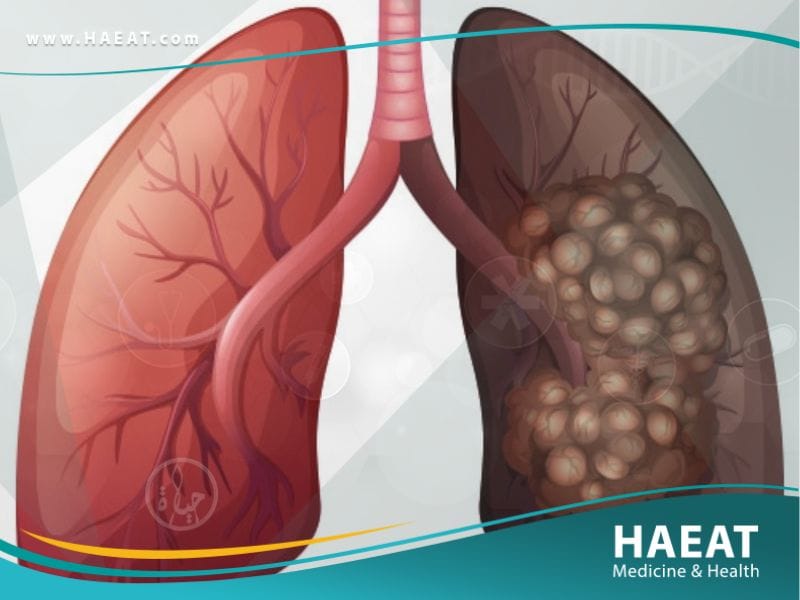 سرطان الرئه