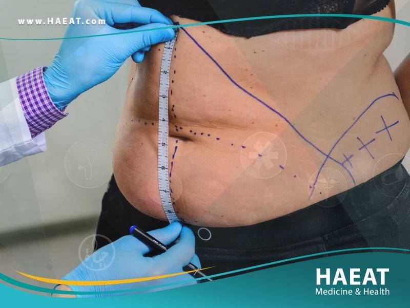 شد البطن في تركيا