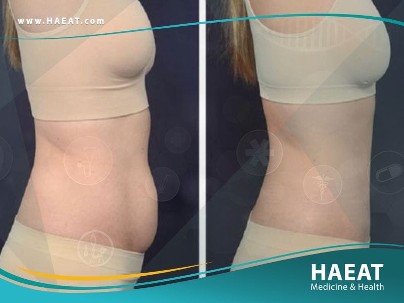 شد البطن في تركيا