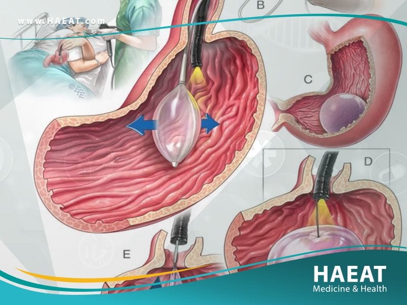 عملية بالون المعدة