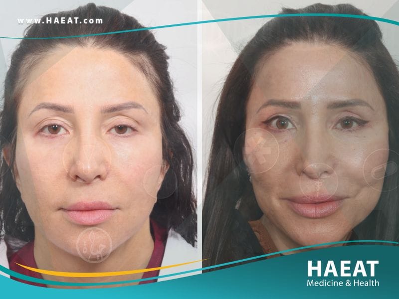 قبل وبعد زراعة الشعر