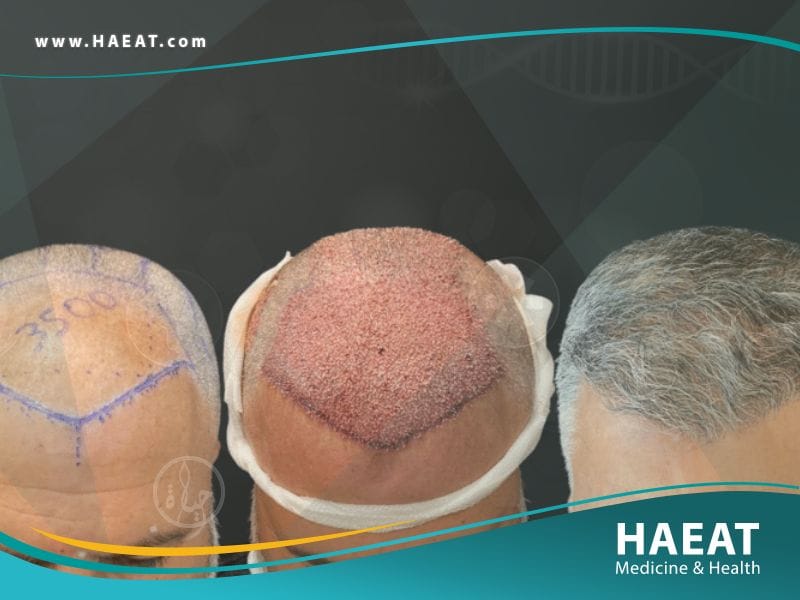 قبل وبعد زراعة الشعر