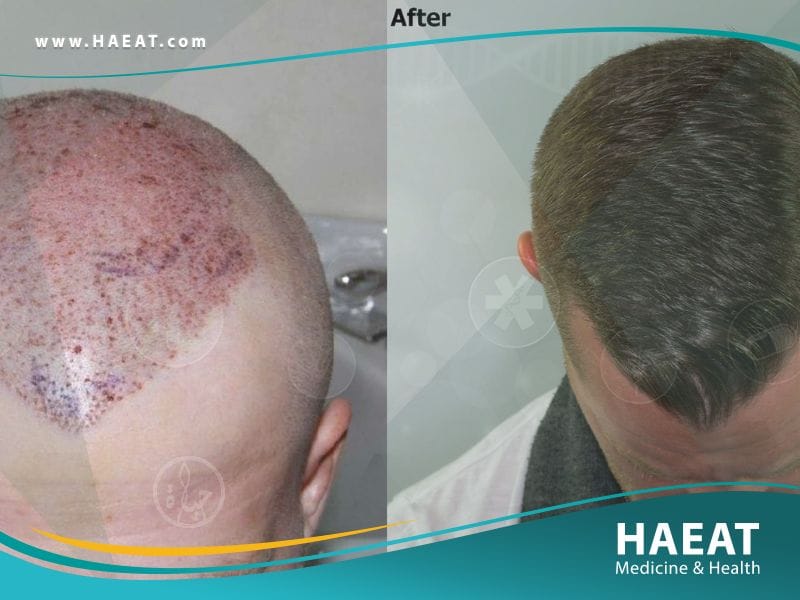 قبل وبعد زراعة الشعر