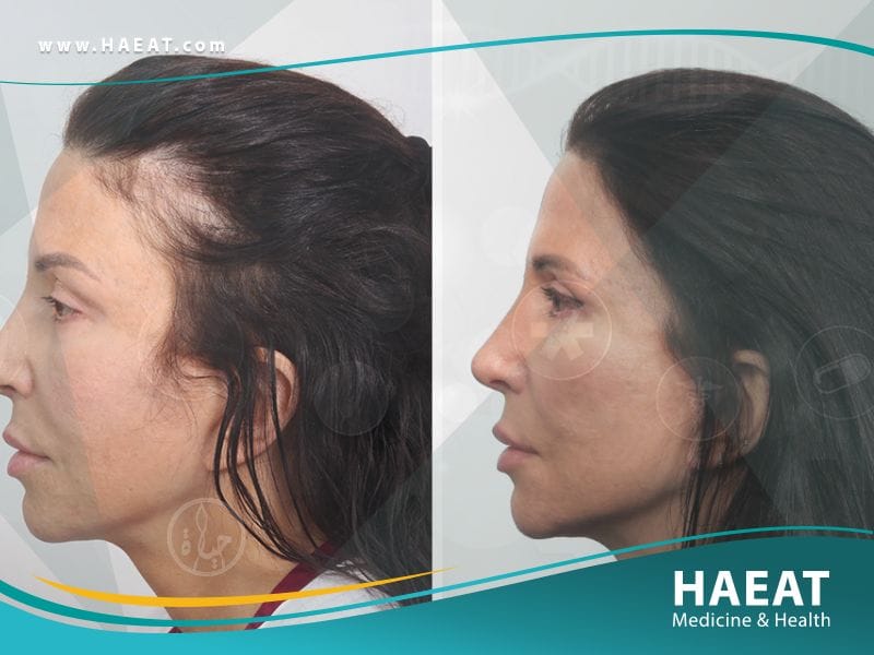 قبل وبعد زراعة الشعر