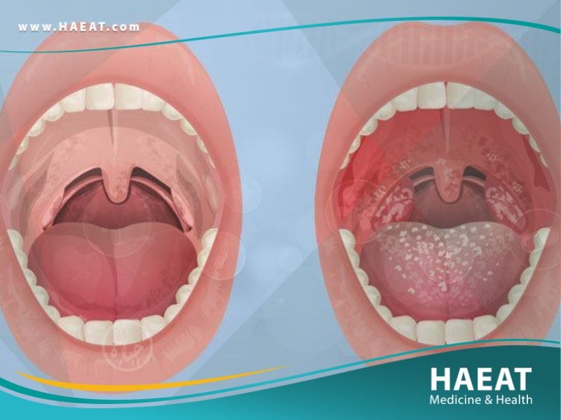 التهابات الفم والبلعوم واللوزتين