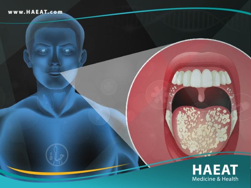 التهابات الفم والبلعوم واللوزتين