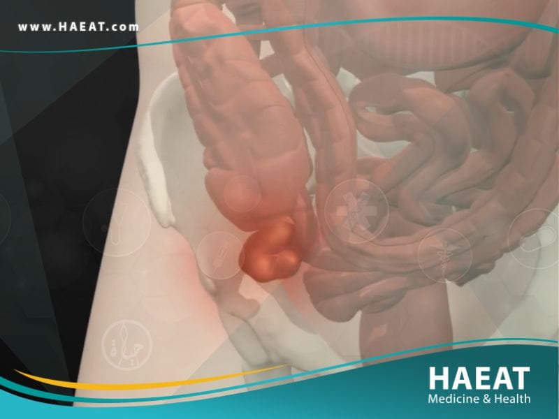 التهاب الزائدة الدودية