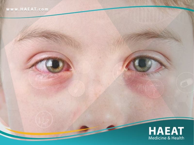 التهاب العين