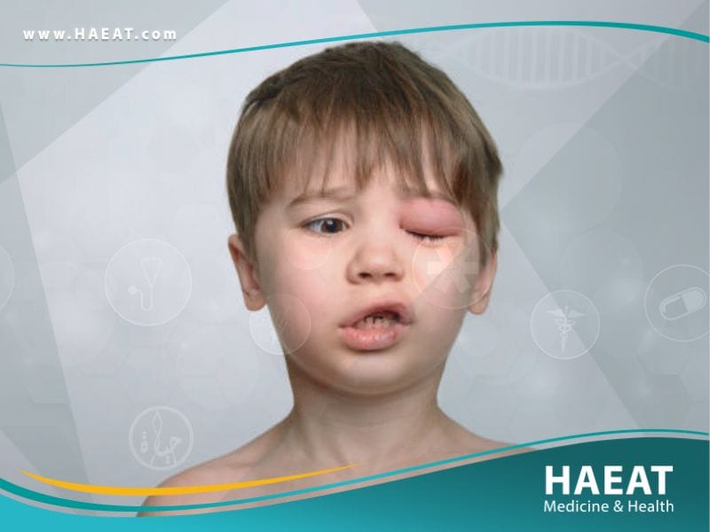 التهاب العين