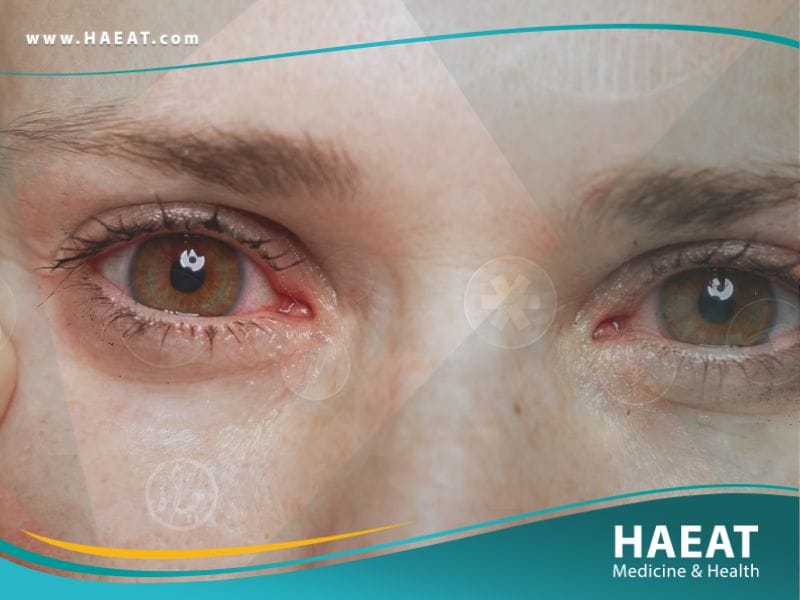 التهاب العين