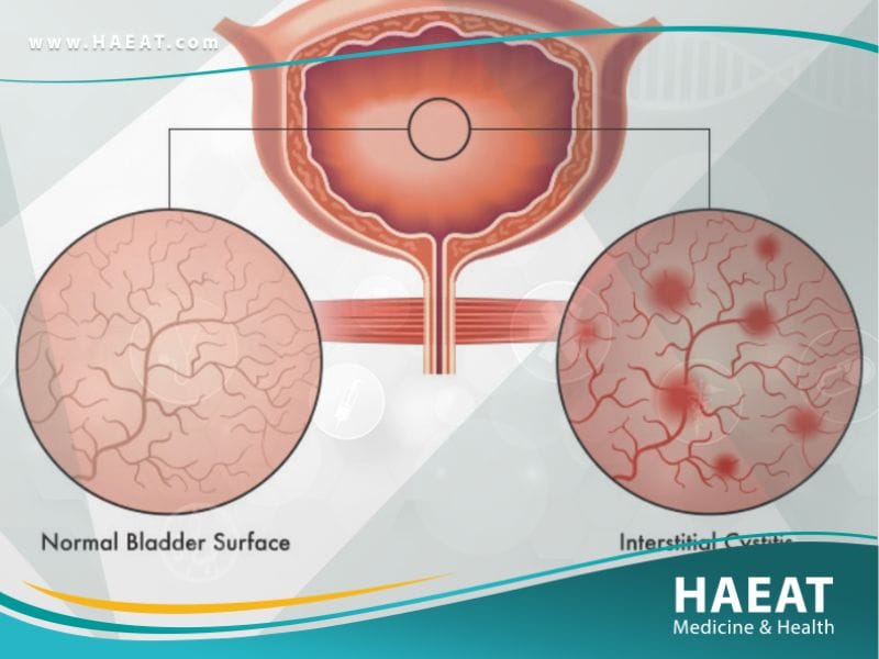 التهاب المثانة