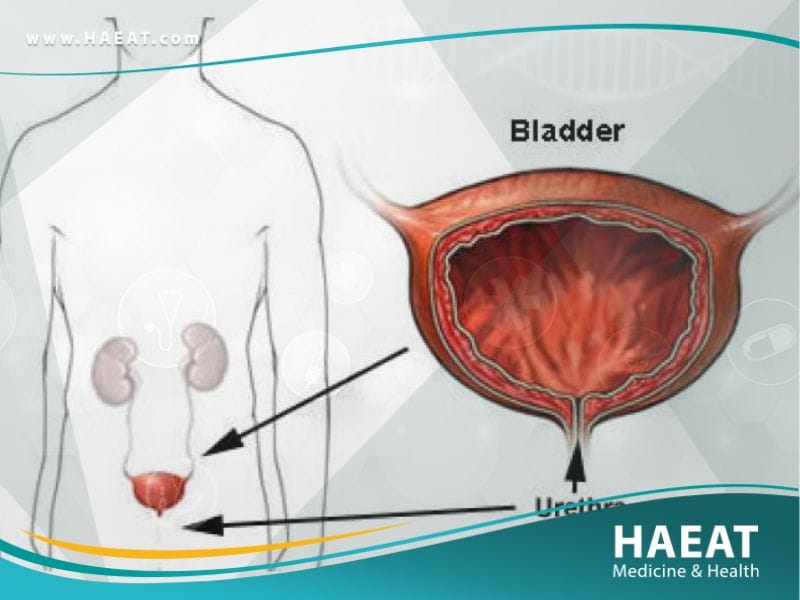 التهاب المثانة