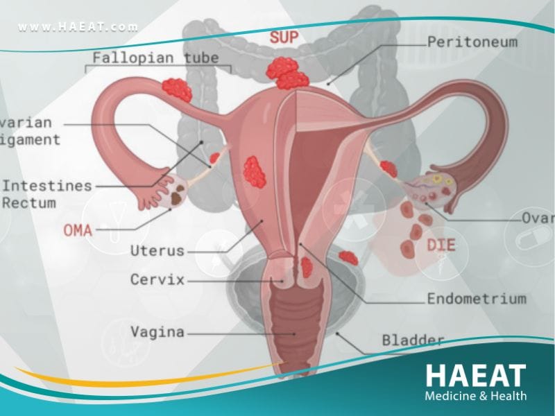 التهاب بطانة الرحم: 7 علامات تحذيرية ودليل العلاج الشامل 22 التهاب بطانة الرحم