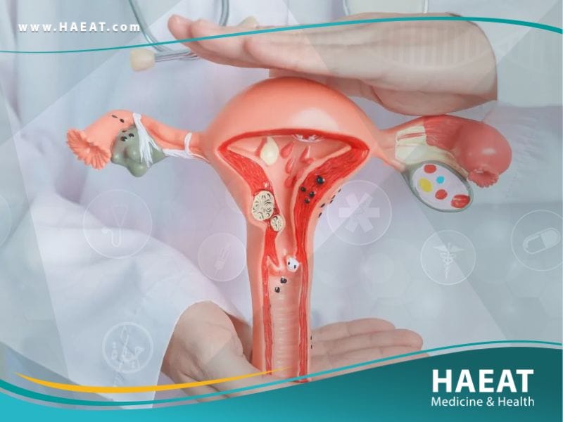التهاب بطانة الرحم: 7 علامات تحذيرية ودليل العلاج الشامل 26 التهاب بطانة الرحم