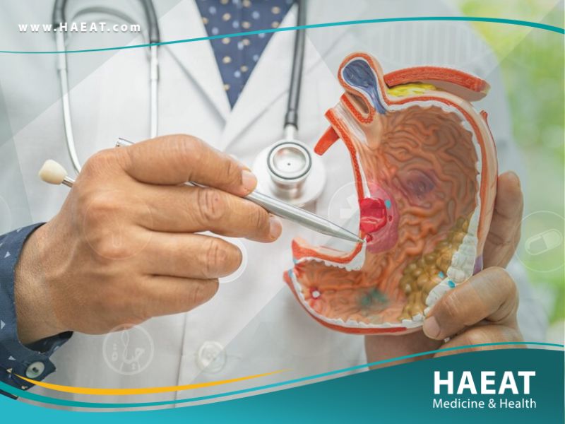 سرطان المعدة 30 سرطان المعدة
