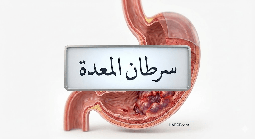 سرطان المعدة | 8 حقائق عن عوامل الخطر، العلاج، والأسباب 20 image 218