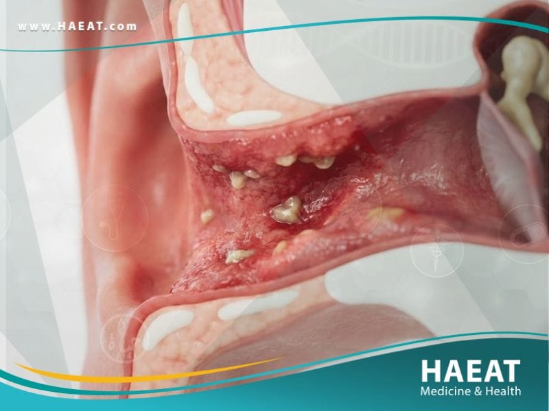 الالتهابات المزمنة في الأذن الخارجية