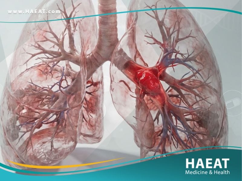 الانصمام الرئوي