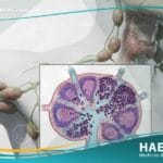 الاورام اللمفاوية