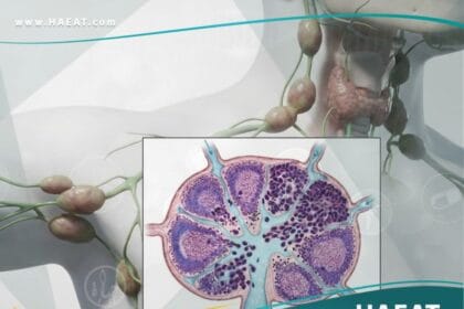 الاورام اللمفاوية