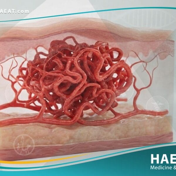 الاورام الوعائية