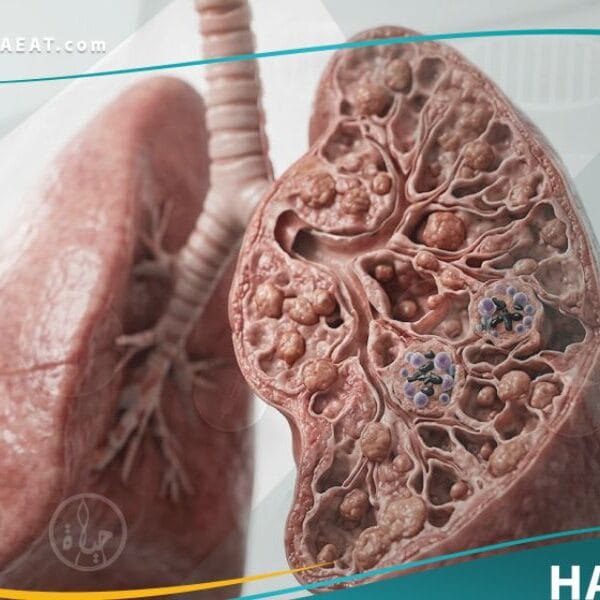 _التسمم بالبريليوم