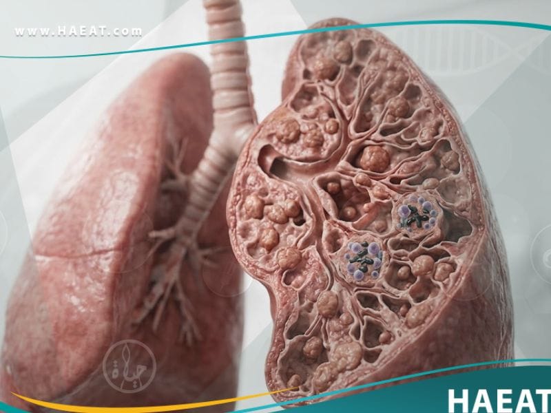 _التسمم بالبريليوم