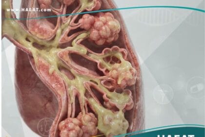 التليف الكيسي