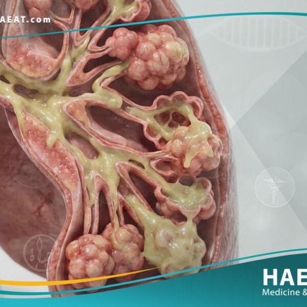 التليف الكيسي