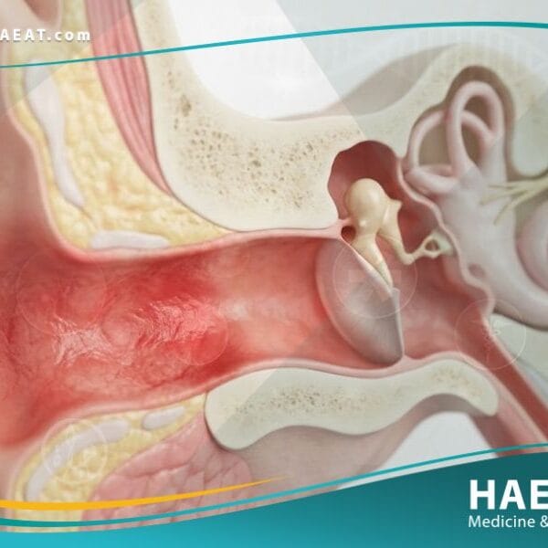 التهاب الأذن الظاهرة