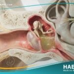 التهاب الأذن الوسطى المزمن (1)