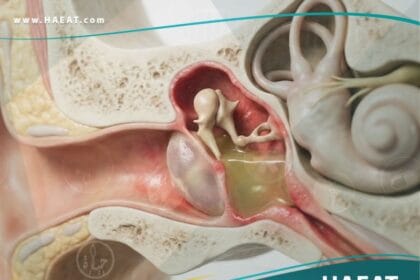 التهاب الأذن الوسطى المزمن (1)