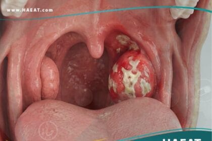 التهاب البلعوم واللوزتين