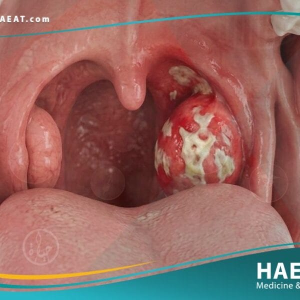 التهاب البلعوم واللوزتين