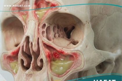 التهاب الجيوب الأنفية المزمن