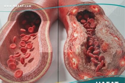 التهاب الشرايين
