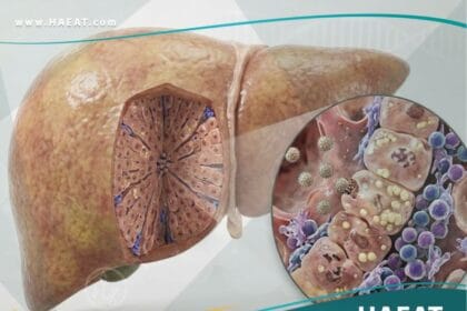 التهاب الكبد الفيروسي