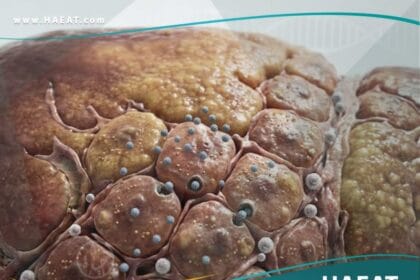 التهاب الكبد ب