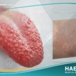 الحمى القرمزية