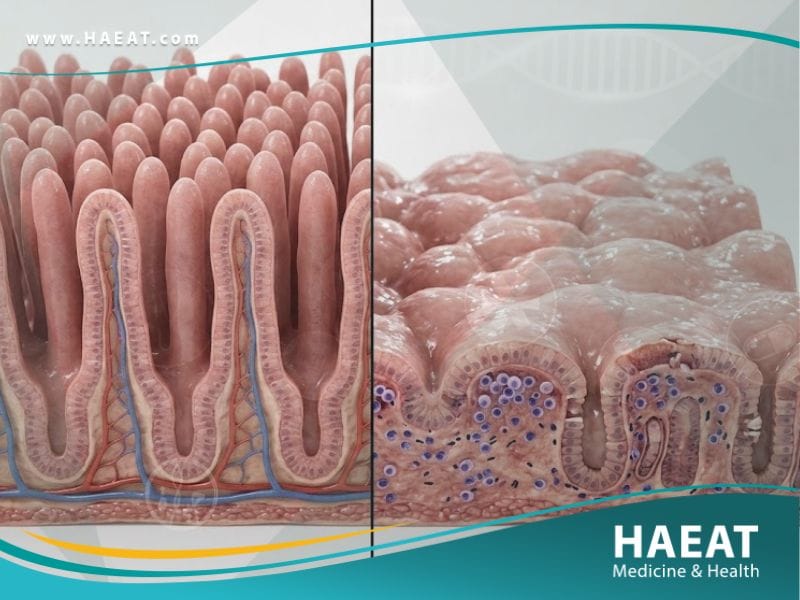 الداء الزلاقي