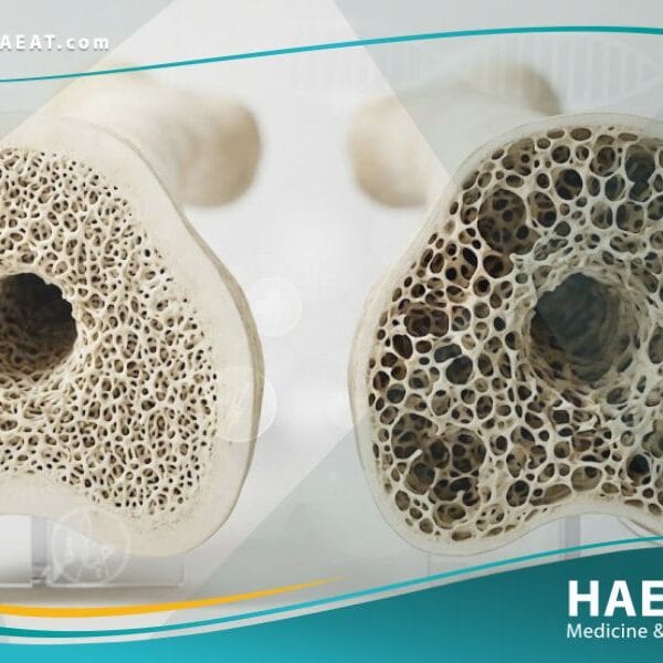 هشاشة العظام