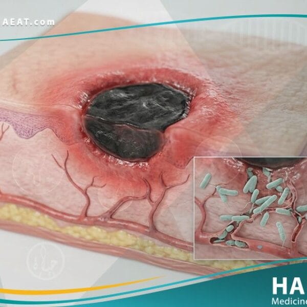 ألاكثيمة الغنغرينية