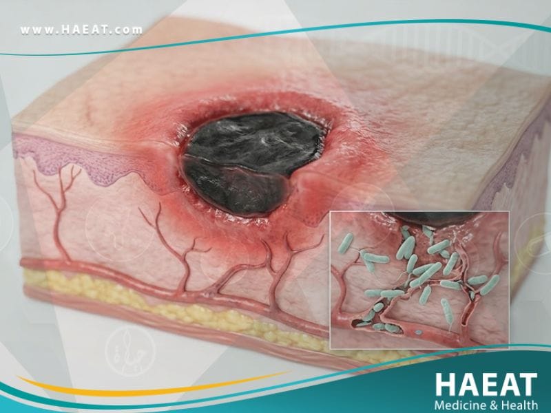 ألاكثيمة الغنغرينية