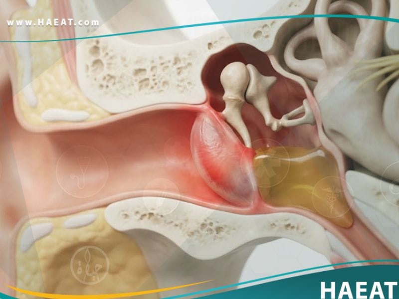 أمراض الأذن الوسطى