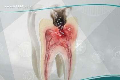 _أمراض التهاب اللب