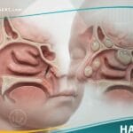 أمراض خلقية في الأنف والجيوب الأنفية