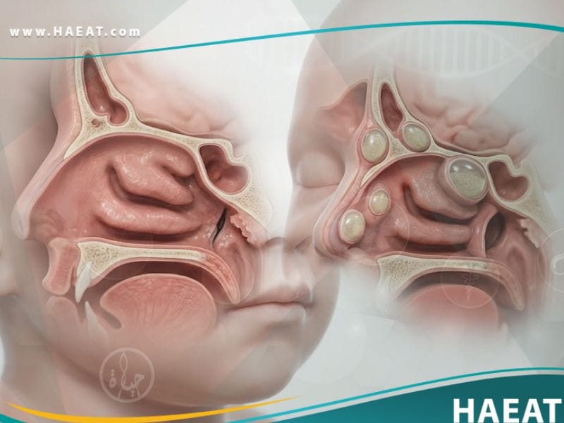 أمراض خلقية في الأنف والجيوب الأنفية