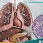 أورام عصبية صماوية