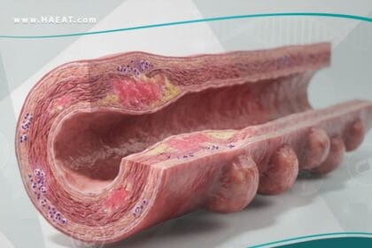 إلتهاب الشرايين العقدي الكلي